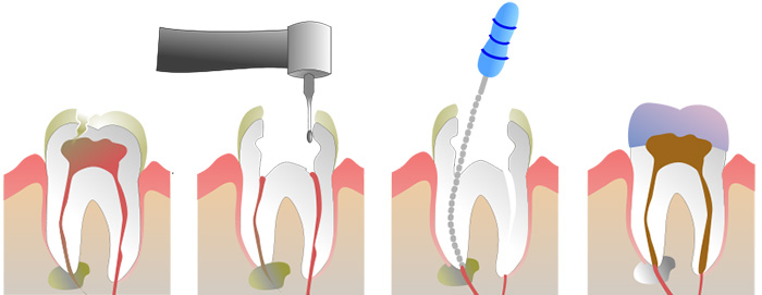 Root-Canals